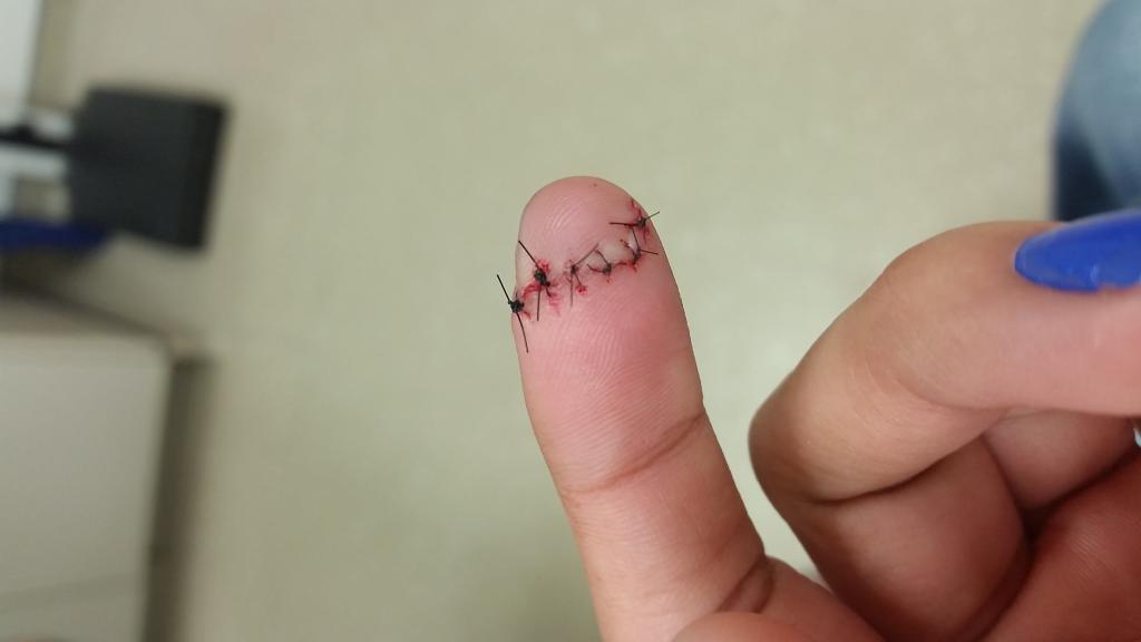 Зашитая рана на пальце.