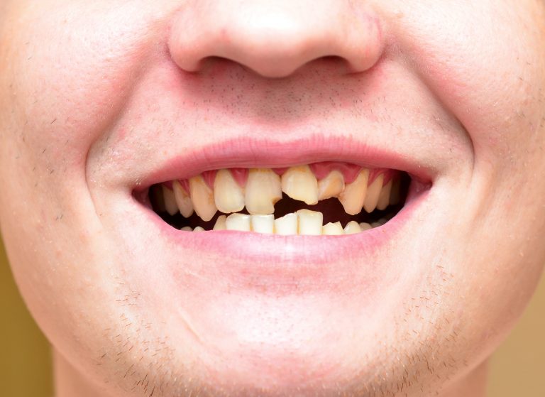 Сломанные зубы у мужчины