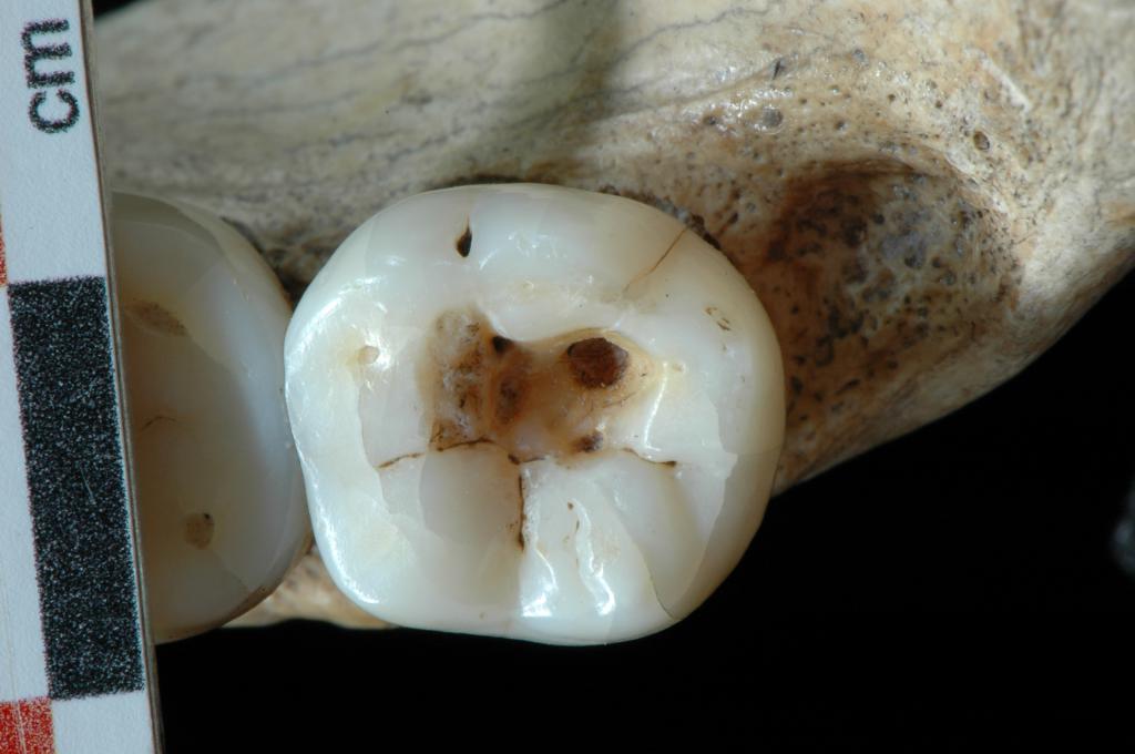 Больной зуб у скелета