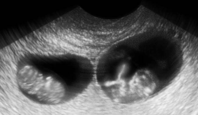 беременность двойней сонник