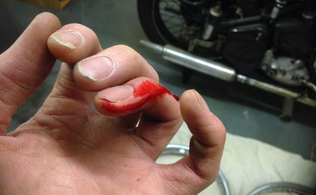 Мотоциклист порезал палец.