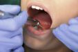 К чему снится сверлить зубы у стоматолога